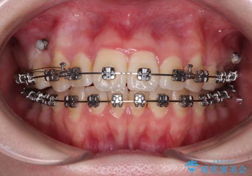 【モニター】八重歯を片側の抜歯矯正で治す メタルブラケット装置の治療中