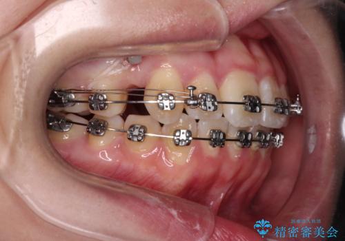 【モニター】八重歯を片側の抜歯矯正で治す　メタルブラケット装置の治療中