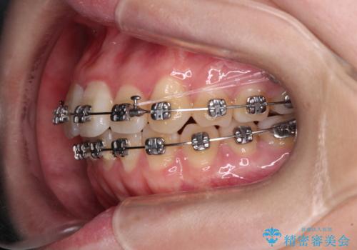 【モニター】八重歯を片側の抜歯矯正で治す　メタルブラケット装置の治療中
