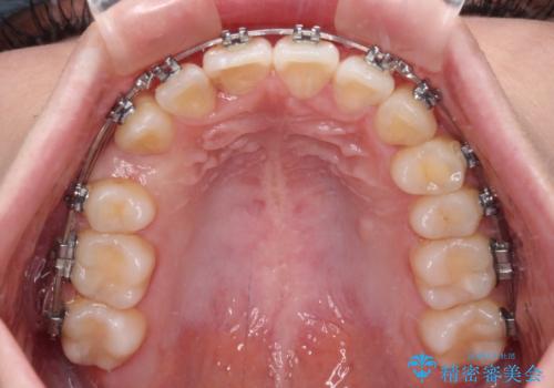 【モニター】八重歯を片側の抜歯矯正で治す メタルブラケット装置の治療中