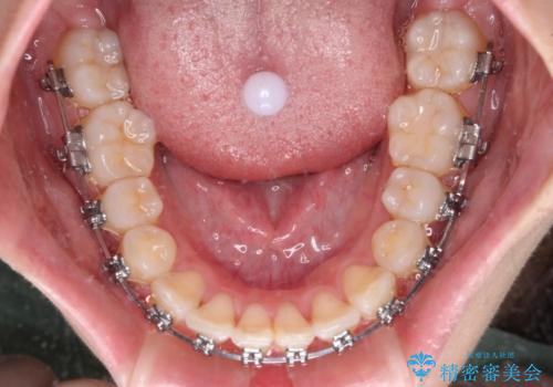 【モニター】八重歯を片側の抜歯矯正で治す メタルブラケット装置の治療中