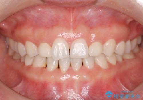 歯の形気になる!! セラミック治療 前歯( エクセレント)の治療後