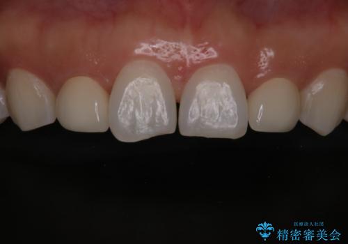 歯の形気になる!! セラミック治療 前歯( エクセレント)の治療後