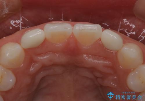 歯の形気になる!! セラミック治療 前歯( エクセレント)の治療後