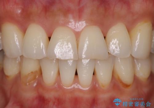 前歯の形気になる　セラミッククラウン(SP)の症例 治療前