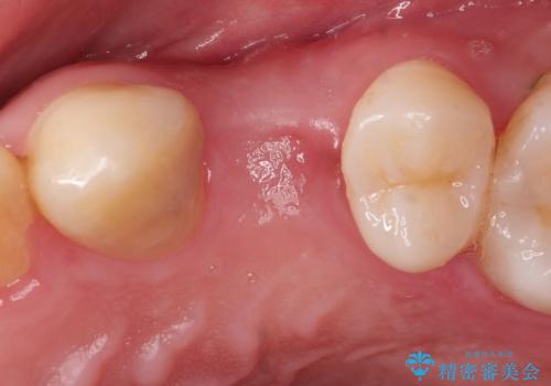 【インプラント】歯が無いので入れて欲しい!の治療中