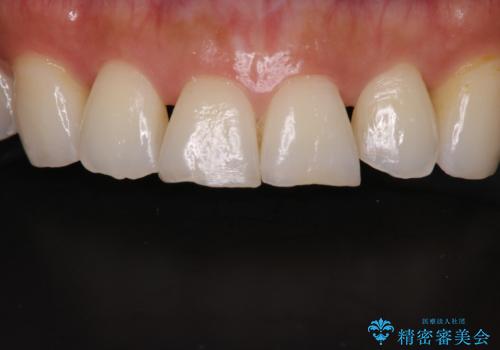前歯の形気になる セラミッククラウン(SP)の治療前