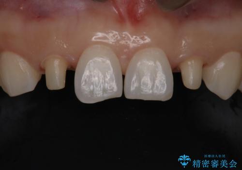 歯の形気になる!! セラミック治療 前歯( エクセレント)の治療中
