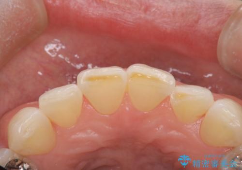 前歯の形気になる セラミッククラウン(SP)の治療中