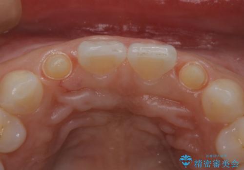 歯の形気になる!! セラミック治療 前歯( エクセレント)の治療中