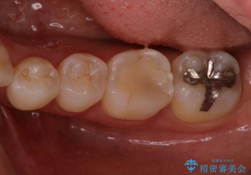 銀歯を無くしたい　セラミックインレーの治療前