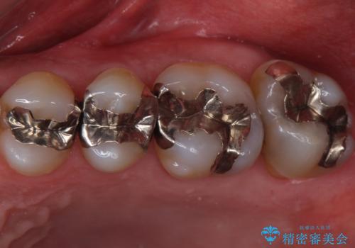 奥歯の虫歯　ゴールドインレーでの修復処置の治療前