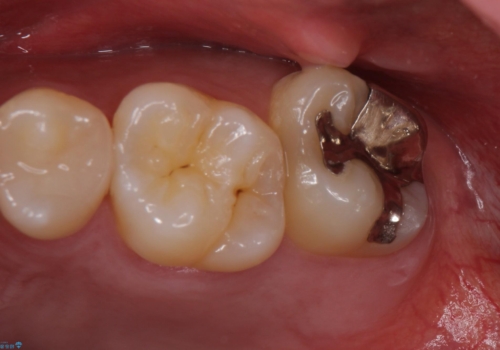 歯ぐきの形を整え、外れにくい被せ物を装着の治療前