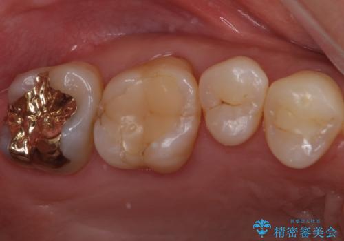 不適な樹脂の詰め物　被せ物で被覆の症例 治療前