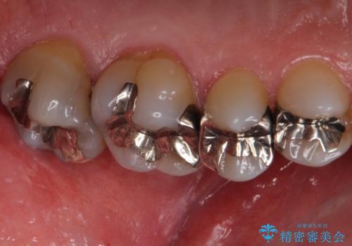 奥歯の虫歯 ゴールドインレーでの修復処置の治療前