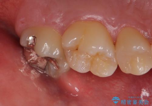 歯ぐきの形を整え、外れにくい被せ物を装着の症例 治療前