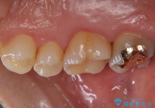 不適な樹脂の詰め物 被せ物で被覆の治療前