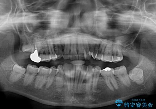 【モニター】再矯正でデコボコの前歯を改善 抜歯矯正の後戻りの治療前