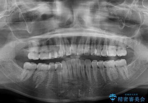 【モニター】八重歯を片側の抜歯矯正で治す　メタルブラケット装置の治療前