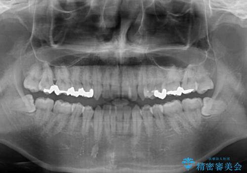 前歯のクロスバイト インビザラインによる矯正治療の治療前