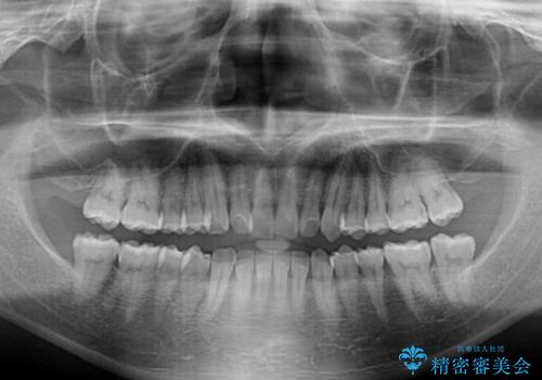 【モニター】前歯のデコボコとクロスバイト ワイヤー矯正で短期間に仕上げるの治療前