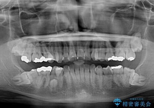 前に飛び出した前歯を治したい ワイヤー装置による抜歯矯正治療の治療前