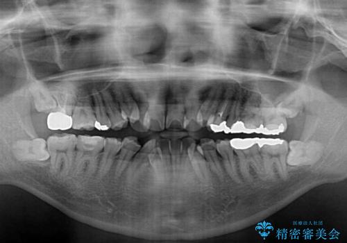 デコボコを治したい 八重歯の抜歯矯正の治療前