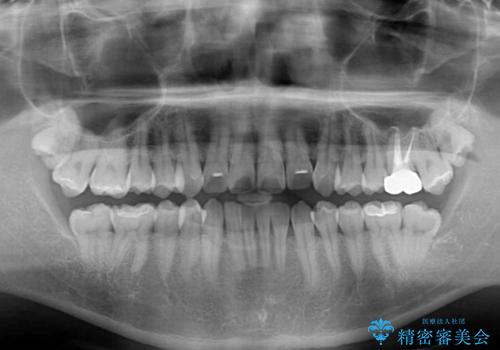 前歯のデコボコを治したい インビザライン矯正治療の治療前