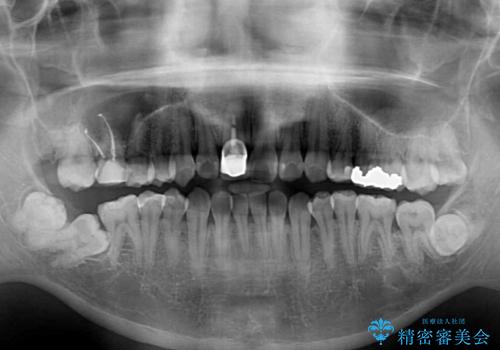 前歯のデコボコとクロスバイトをインビザライン矯正で改善の治療前