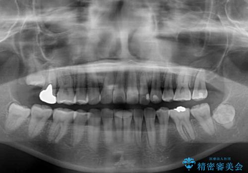 【モニター】再矯正でデコボコの前歯を改善　抜歯矯正の後戻りの治療後
