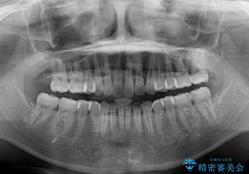 【モニター】八重歯を片側の抜歯矯正で治す　メタルブラケット装置の治療後