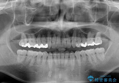 前歯のクロスバイト　インビザラインによる矯正治療の治療後