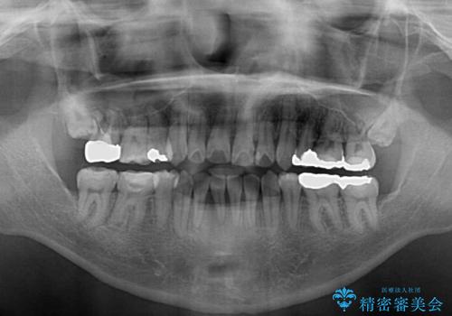 デコボコを治したい 八重歯の抜歯矯正の治療後