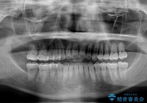 【モニター】前歯のデコボコとクロスバイト　ワイヤー矯正で短期間に仕上げるの治療後