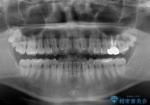 前歯のデコボコを治したい インビザライン矯正治療の治療後