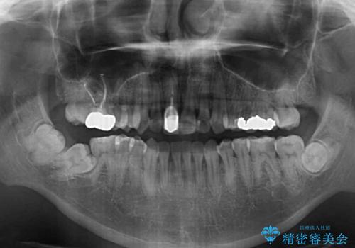 前歯のデコボコとクロスバイトをインビザライン矯正で改善の治療後