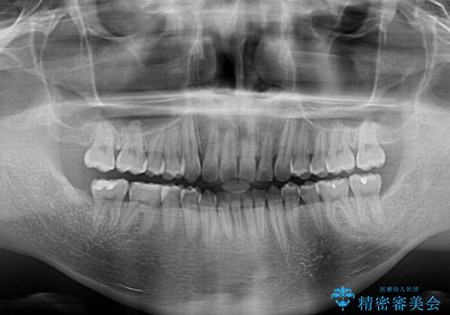 前歯のデコボコを費用を抑えたメタルブラケットできれいにの治療後