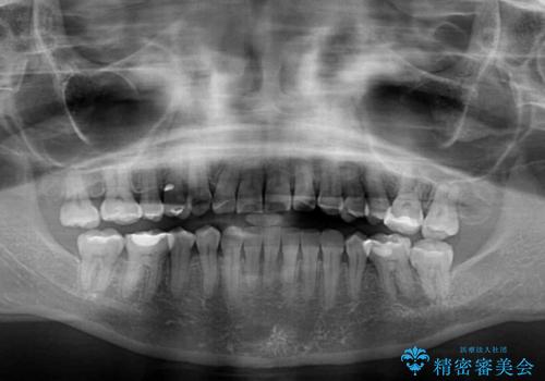 骨格のずれをカムフラージュ クロスバイトのワイヤー矯正の治療後