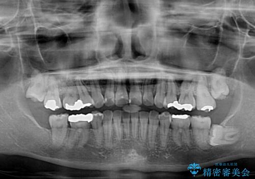前に飛び出した前歯を治したい ワイヤー装置による抜歯矯正治療の治療後