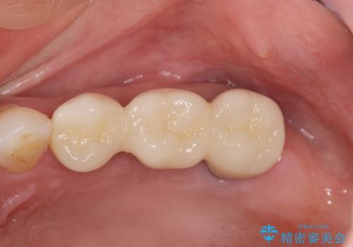 歯槽堤保存を行ったブリッジ治療の治療後