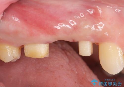 強い咬合力クリアランスの問題を解決したメタルボンドブリッジ治療の治療中