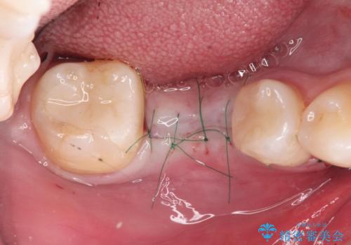 失った歯のインプラント補綴の治療中