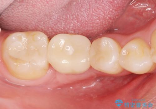 失った歯のインプラント補綴の治療後