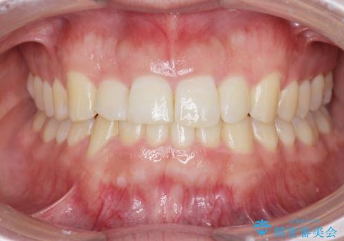 前歯が隠れていて見えない クロスバイトの矯正治療の治療後