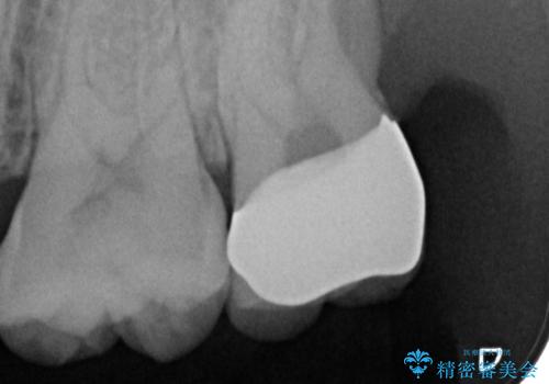 歯ぐきの形を整え、外れにくい被せ物を装着の治療後