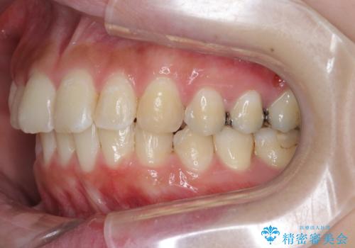 [ 出っ歯を治したい ]　マイクロインプラントを用いた大きな後方移動の治療後