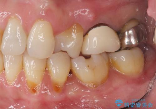 歯槽堤保存を行ったブリッジ治療の治療前