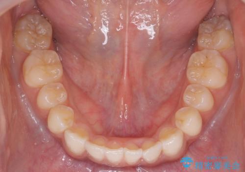 前歯のがたつき 1年かからず治療 マウスピース矯正の治療後