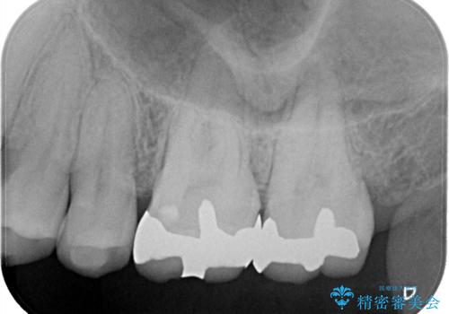 【メタルフリー】セラミックインレーの修復の治療前