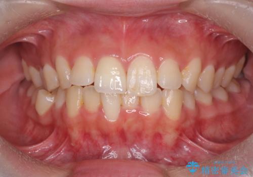 [ 前歯のセラミック治療 ]  変色した前歯を綺麗にしたいの治療後